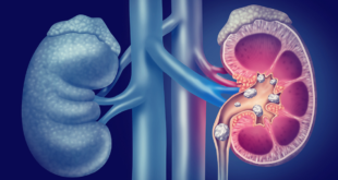 What causes kidney stones